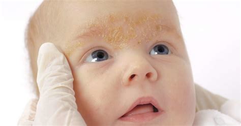 Rash On A Babys Face Pictures Causes And Treatments