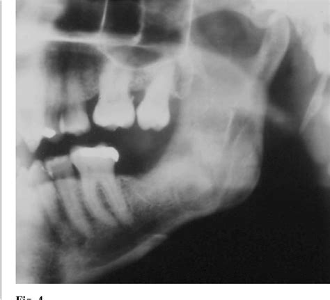 Figure 4 From Tumor Odontogénico Epitelial Calcificante Tumor De