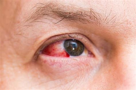 Red Spots On The Eyes Due To Subconjunctival Bleeding This Is The