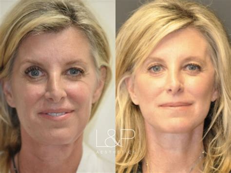 Facelift And Neck Lift For Beautiful 49 Year Old Woman