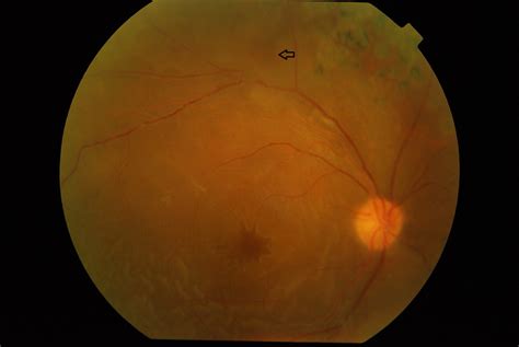 Pneumatic Retinopexy For Treatment Of Posterior Pole Detachment