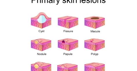 Description Of Primary Skin Lesions 1 Macule A Flat Colored Lesion