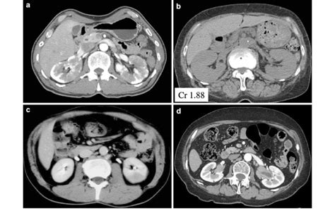 This phase is also useful to help differentiate a renal pseudotumor from a renal neoplasm. Characteristic renal computed tomography (CT) imaging. a ...