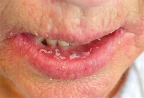 Do I Have A Fungal Infection On My Lips Lipstutorial Org