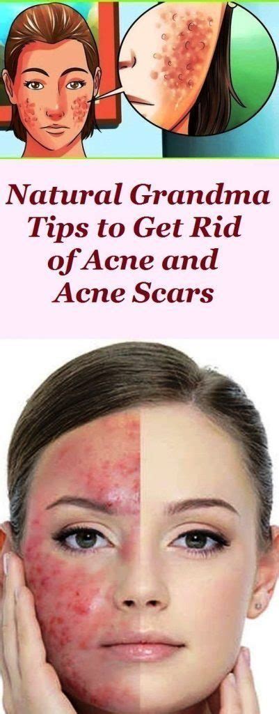 Natural Grandma Tips To Get Rid Of Acne And Acne Scars