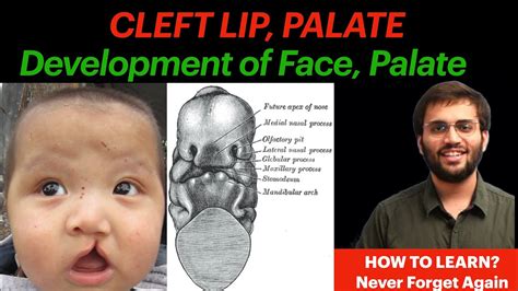 Development Of Palate Face Embryology Cleft Lip Cleft Palate