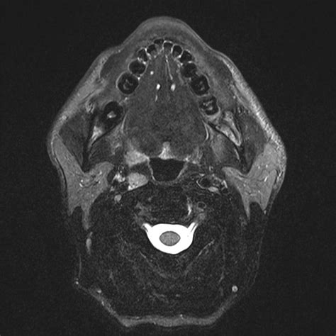 Tonsillar Squamous Cell Carcinoma Image