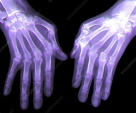 Frontal view, one or two oblique views and a lateral view are standard views. Rheumatoid arthritis of the hands, X-ray - Stock Image ...