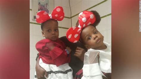 Nigerian Conjoined Twins Successfully Separated By 78 Member Team In