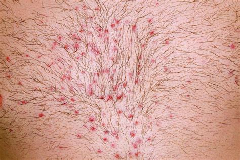 Folliculitis After Chest Waxing Photograph By Dr P Marazziscience Photo Library