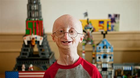 Progeria Le Syndrome Du Vieillissement Accéléré La Génétique