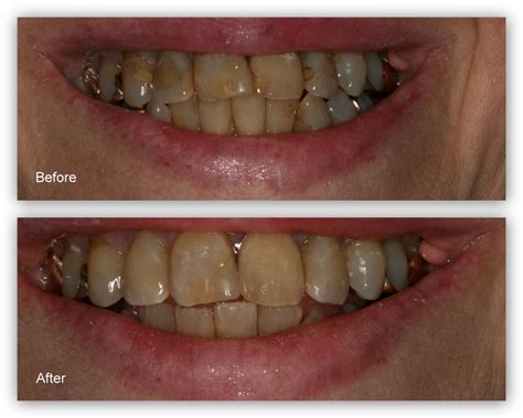 Tooth Colored Fillings Gallery Dr Jack M Hosner Dds