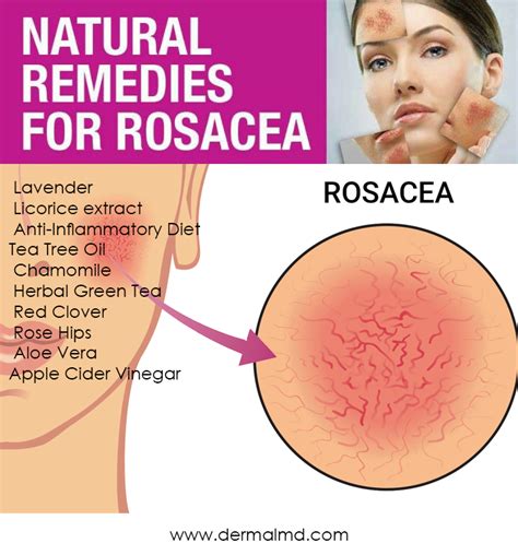 Rosacea Treatment Shop Natural Remedies For Rosacea Rosacea Skin