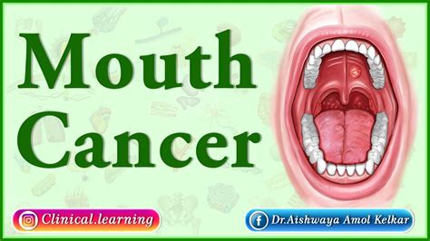 Mouth Cancer Causes And Symptoms Youtube