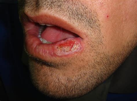 Oral Lichen Planus Causes Symptoms Prognosis Diagnosis Treatment