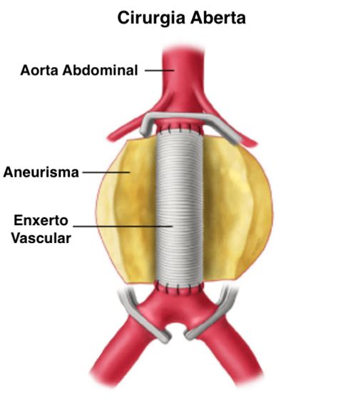 O Que é Um Aneurisma Da Aorta Abdominal