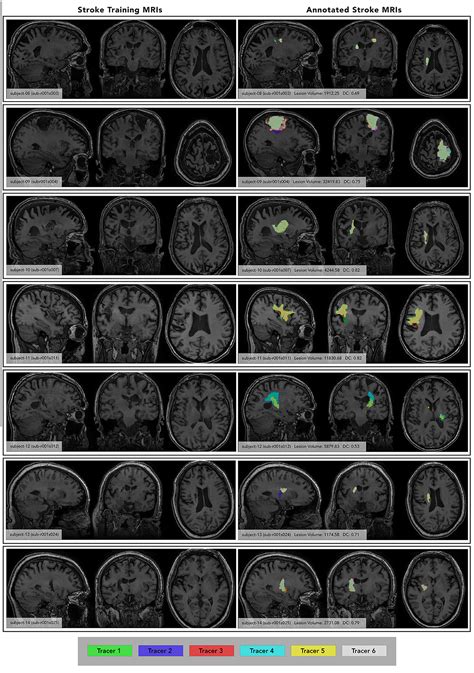 Frontiers A Standardized Protocol For Manually Segmenting Stroke