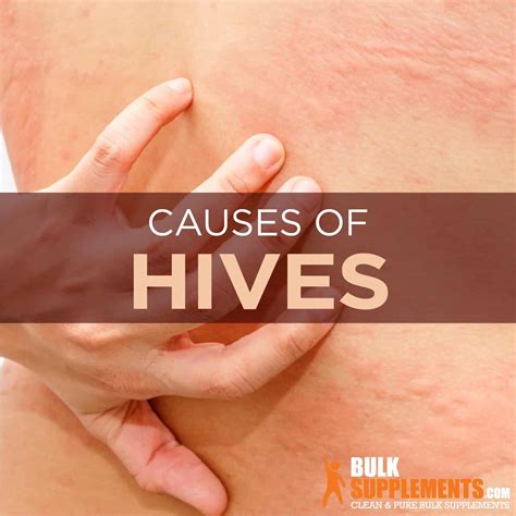 Hives Symptoms Causes And Treatment