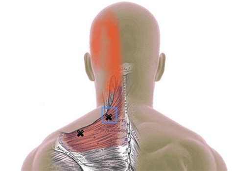 Trigger Points For Migraines And Headaches Chronic Pain Relief