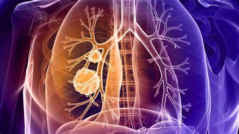 Lung Tumor Causes Types Symptoms Diagnosis And Treatment