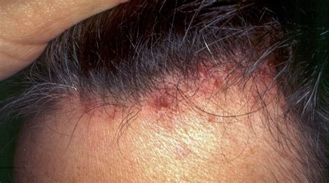 Scalp Folliculitis Is A Typical Skin Condition In Which Hair Follicles