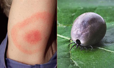 Bullseye Rash Lyme Lyme Disease History And Symptoms Wikidoc