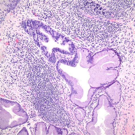 Pathology Outlines Adenocarcinoma In Situ