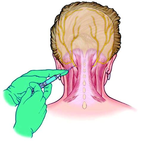 Greater Occipital Nerve Block For Acute Treatment Of Migraine Headache A Large Retrospective