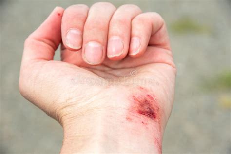 Red Wound On The Palm Arm Wrist After A Burn Or Fall First Aid In