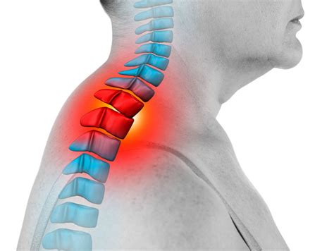 Best Relief For Severe Neck Pain From Chronic Arthritis Stiff Muscles