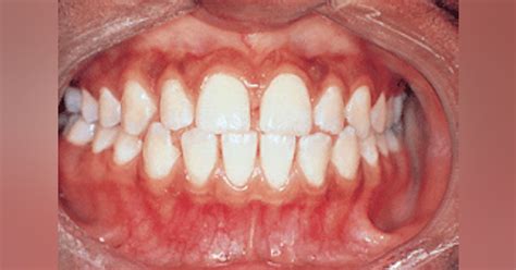 Localized Juvenile Periodontitis Registered Dental Hygienists