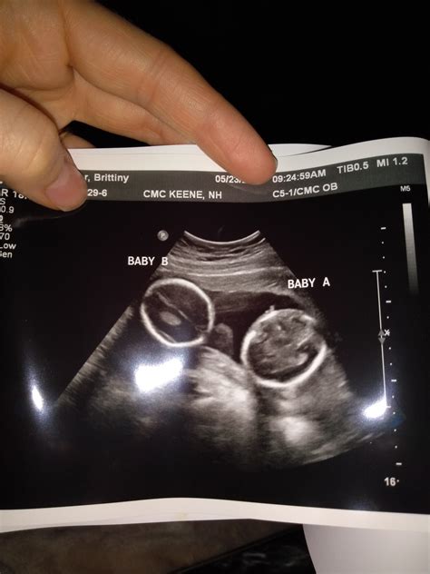 Weeks Pregnant With Twins Belly Symptoms Ultrasound Pictures My Xxx