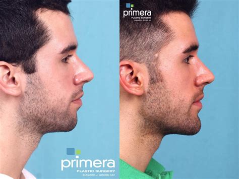 Male Jaw Implant Before And After