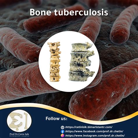 All About Tuberculosis Of The Bone Dr Whats Wrong With You