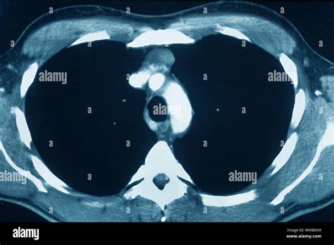 Thymus Cancer Ct Scan Stock Photo Alamy