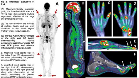 Total Body 18f Fdg Petct Imaging A Tool For Diagnosis And Quantifying