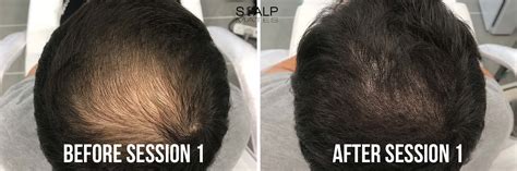 Scalp Micropigmentation Smp For Long Hair In Birmingham Uk Results