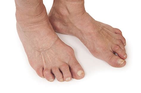 How Rheumatoid Arthritis Affects The Feet