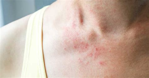 Allergic Eczema Causes Symptoms And Treatment Options