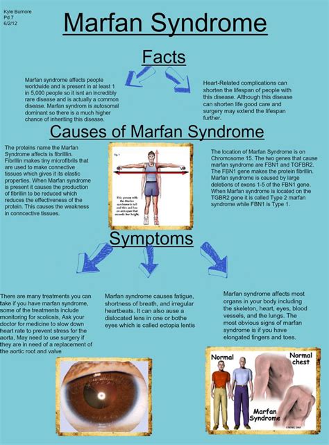 Marfan Syndrome There Are Varying Symptoms For Example My Chest