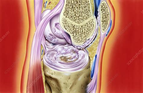 Gout In Knee Joint Artwork Stock Image C Science Photo Library
