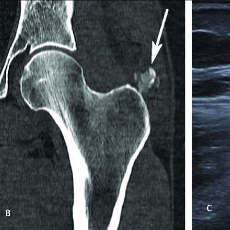 Gluteus Medius Tendonitis