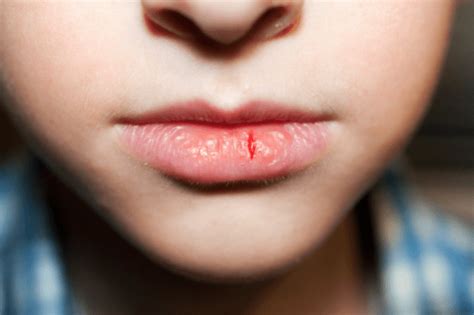 What Causes Cracks In Corner Of Mouth Angular Cheilitis Causes