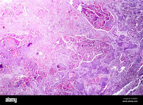 Photomicrograph Of Squamous Cell Carcinoma Of The Lung Showing