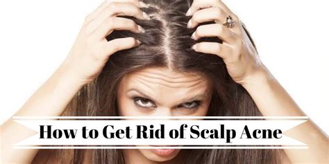 How To Get Rid Of Scalp Acne Natural Home Remedies To Treat Scalp Acne