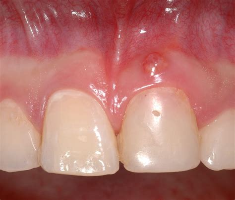 Oral Surgery How To Treat A Dental Fistula Directorio Odontológico