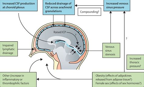 Understanding Idiopathic Intracranial Hypertension Mechanisms