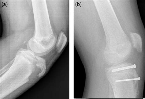 Closed Reduction In The Treatment Of Tibial Tubercle Fractures Injury