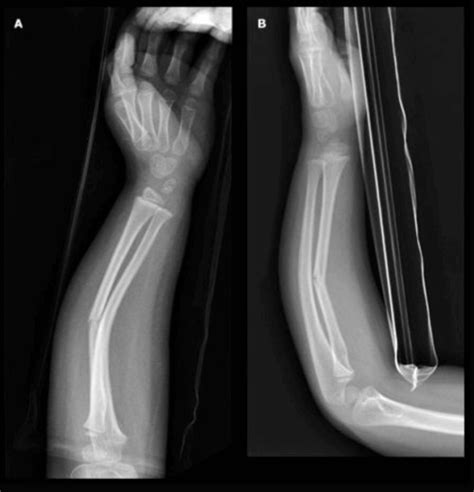 Greenstick Fracture Definition Causes And Treatment