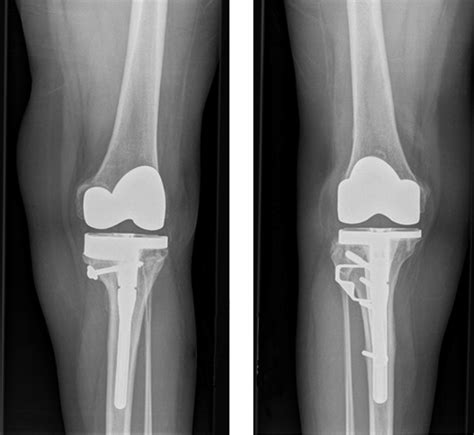 Total Knee Replacement With Rotational Proximal Tibial Osteotomy For